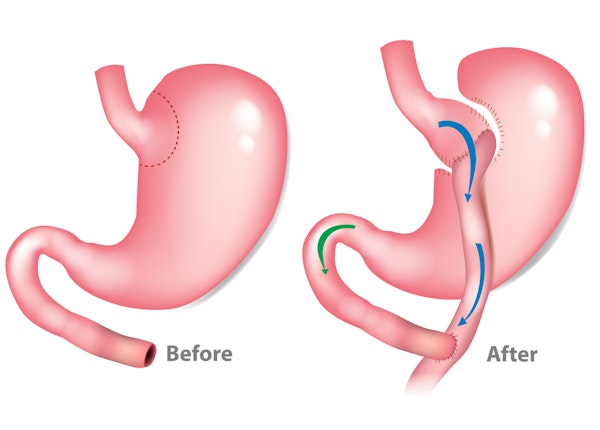 Stomach before and after gastric bypass