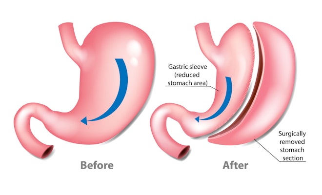 before and after sleeve gastrectomy (after illustration has the gastric sleeve (reduced stomach area) and the surgically removed stomach)