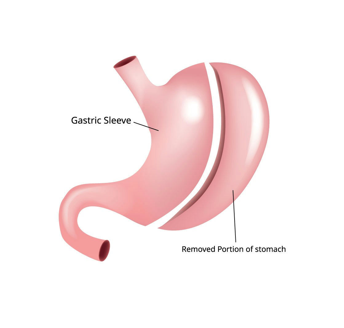 gastric sleeve