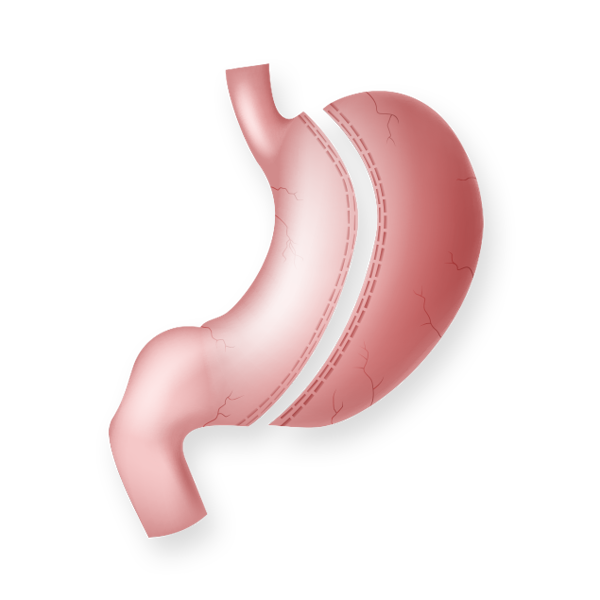 Illustration of a vertical sleeve gastrectomy