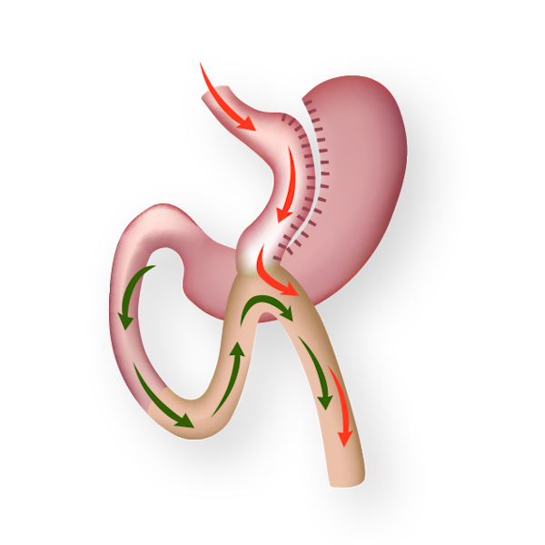 Illustration of gastric bypass
