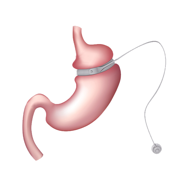 Illustration of a LAP Band